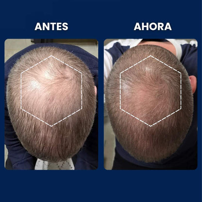 Tratamiento Capilar para Reactivar Folículos Dormidos - Alfagrow® (BK$25)
