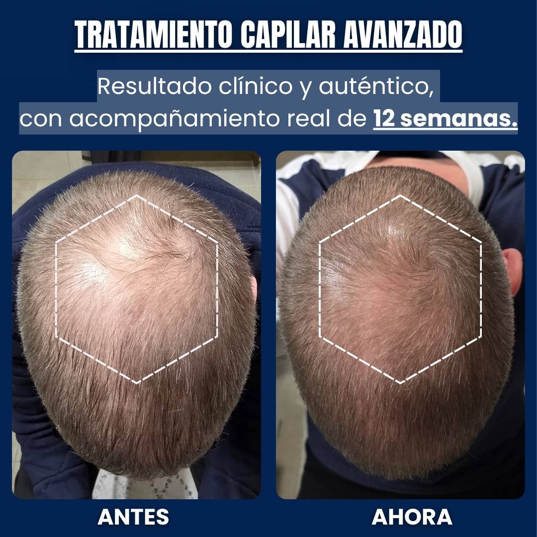 Tratamiento Capilar para Reactivar Folículos Dormidos - Alfagrow® | PACKS