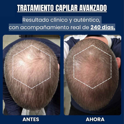 Tratamiento Capilar para Reactivar Folículos Dormidos - Alfagrow® - 3X1